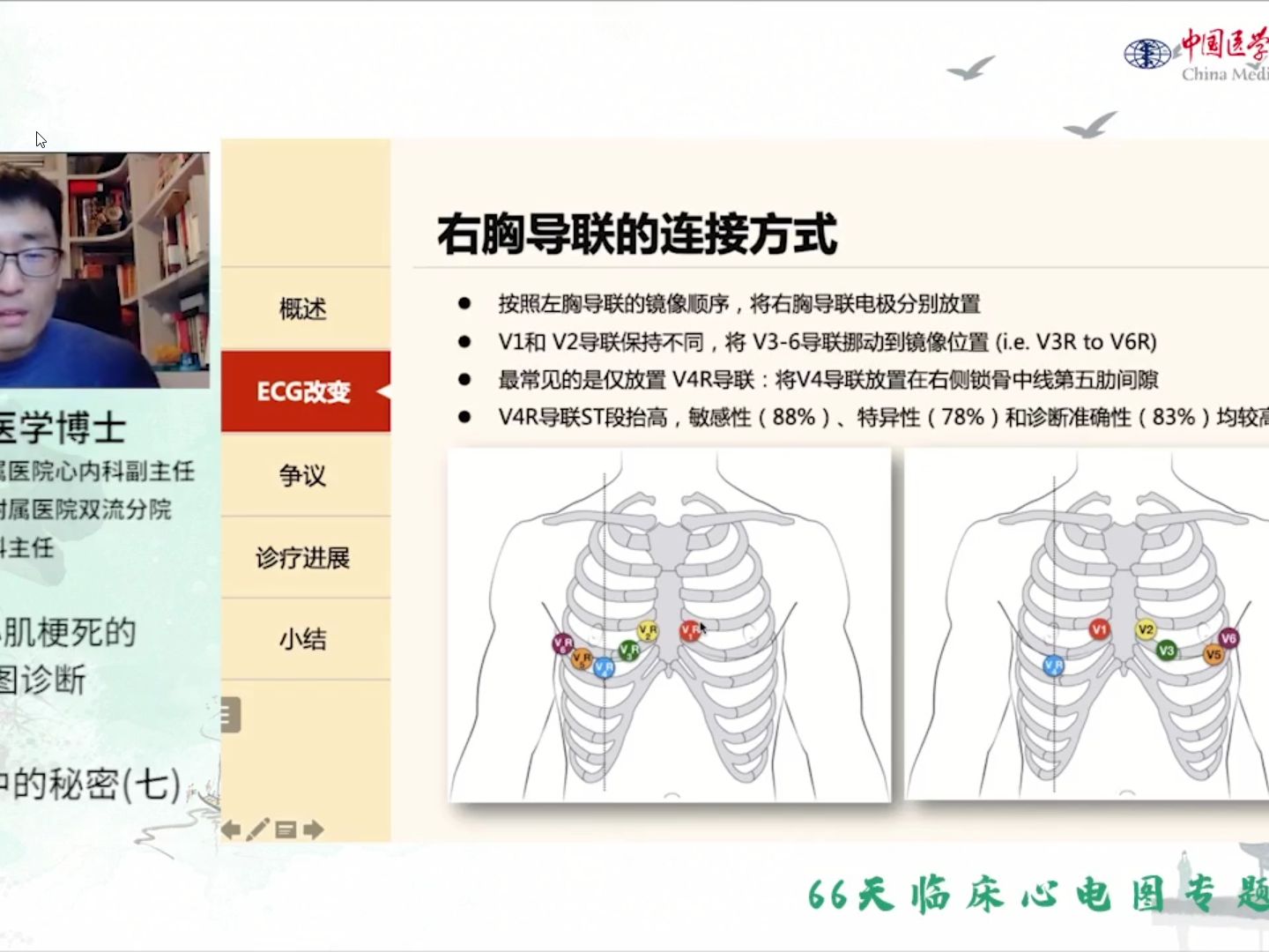 【心电导联】Day7:右心室心肌梗死的心电图诊断哔哩哔哩bilibili