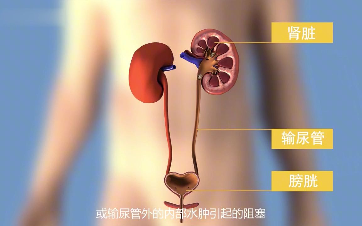 双J管置入术后注意事项哔哩哔哩bilibili