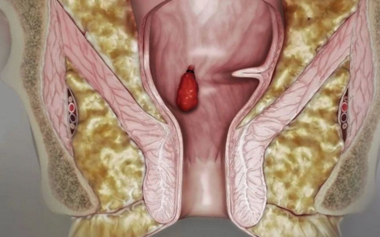 痔疮的症状和前兆你都了解清楚了吗?除了便血和肿痛,这个症状你也得注意了!哔哩哔哩bilibili