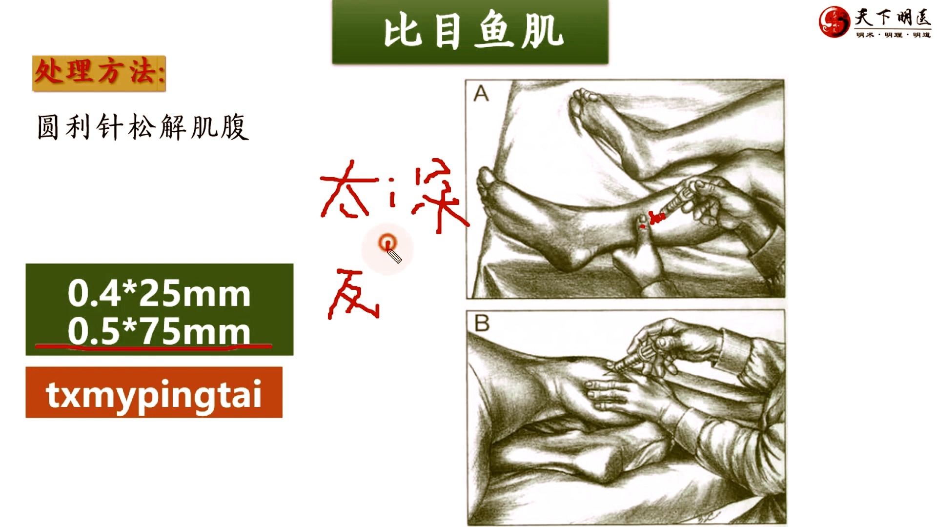 比目鱼肌的位置,比目鱼肌的功能,比目鱼肌的激痛点,比目鱼肌损伤后的