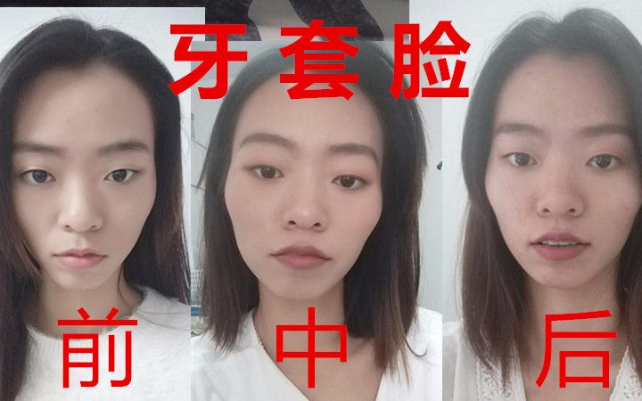 聊聊牙套脸脸颊凹陷颧骨突出怎么办