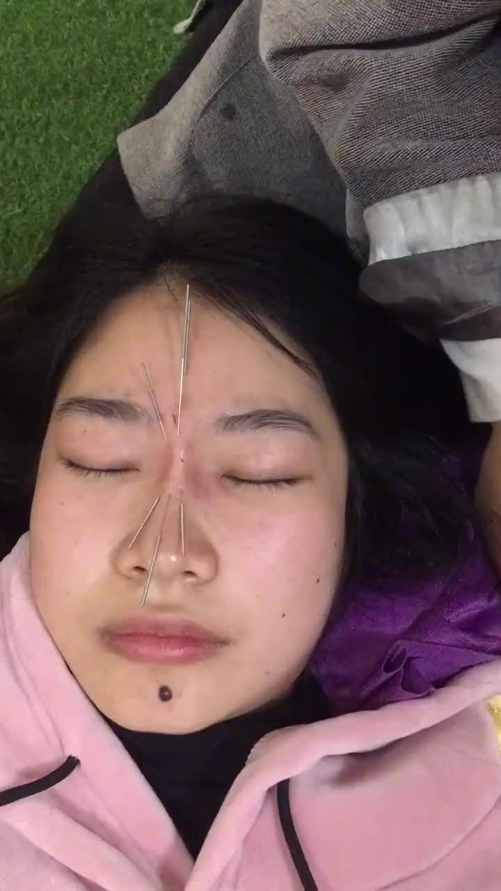就问你们怕不怕,针灸隆鼻,整形外科的医生估计都要下岗了!