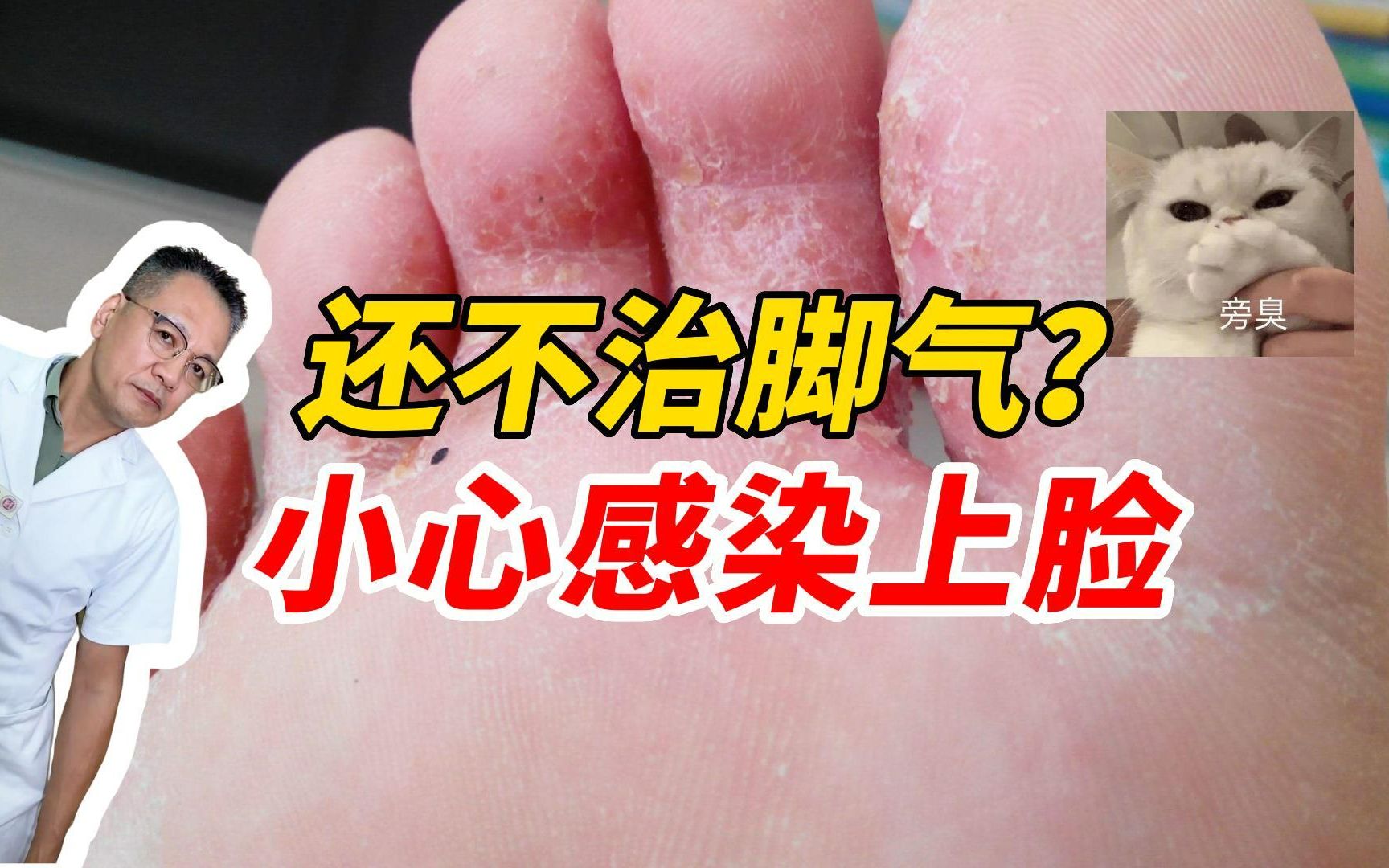 【科普】脚气会传染脸和屁股!