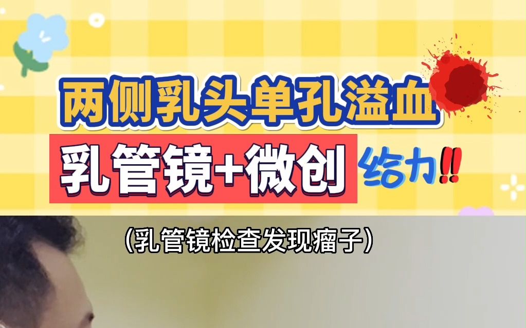 两侧乳头单孔溢血,乳管镜+微创旋切,完美搭配~哔哩哔哩bilibili