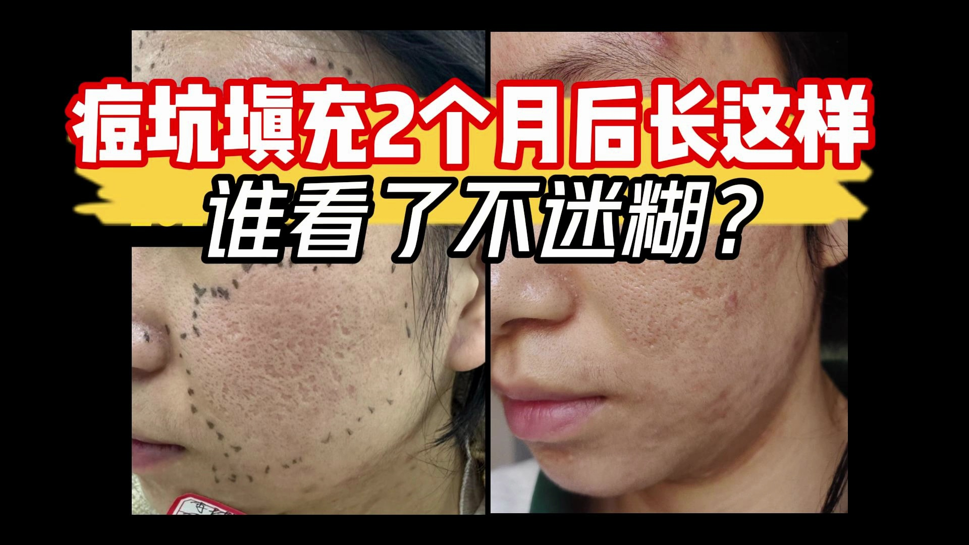 痘坑填充2个月后的效果,坑肉眼可见的变小变少了,给姐的美貌直接还原