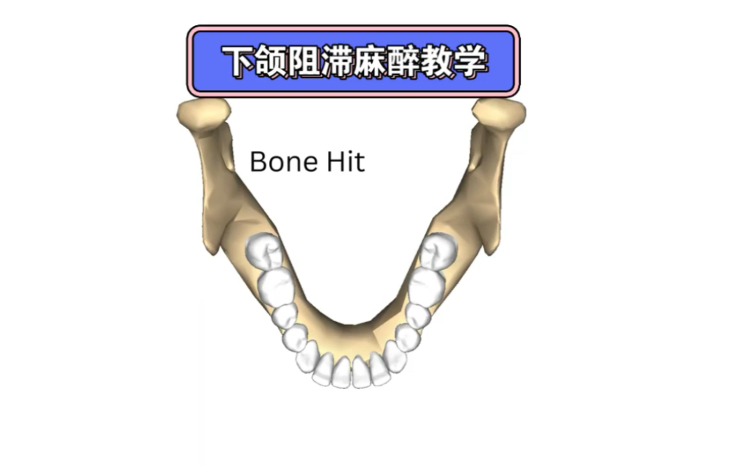 下颌阻滞麻醉 教程图片