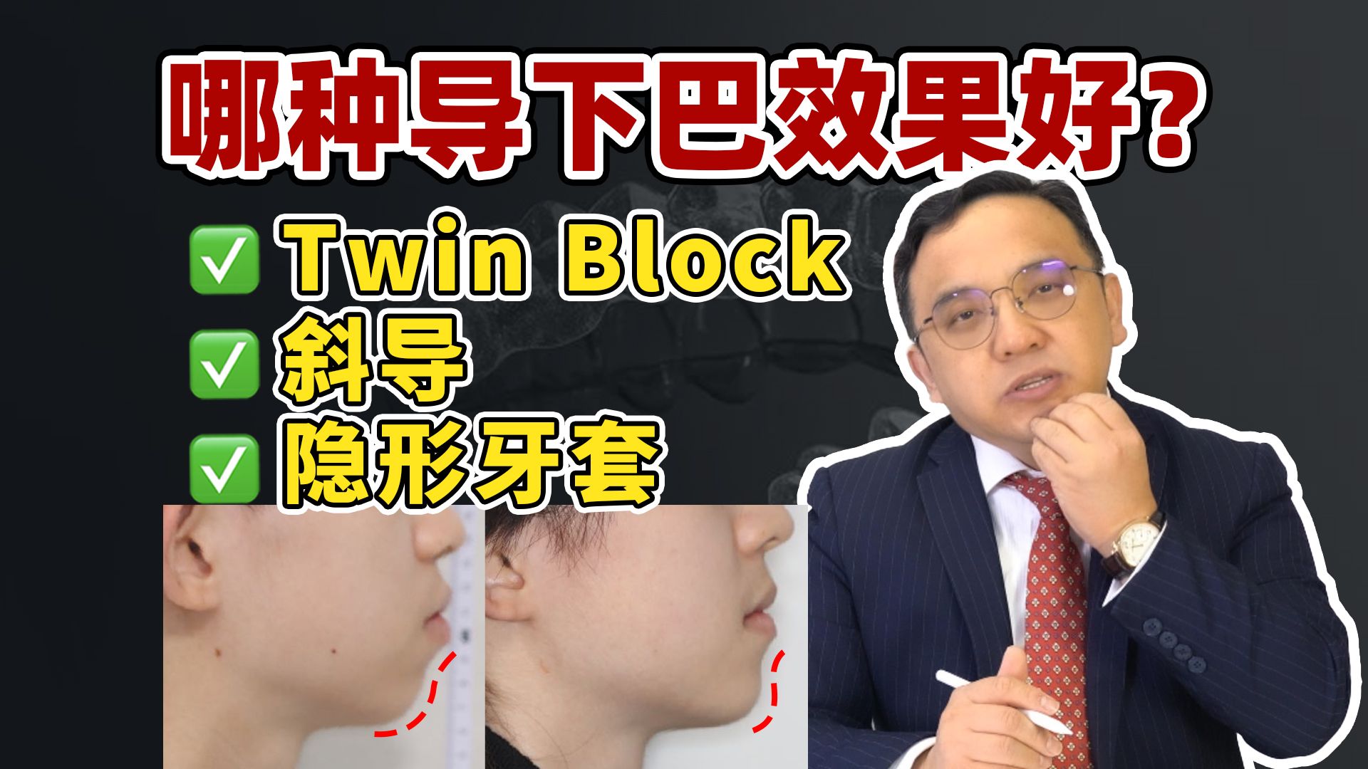 颠覆认知,高角下巴后缩也能戴TwinBlock导下巴?牙齿矫正必看!哔哩哔哩bilibili