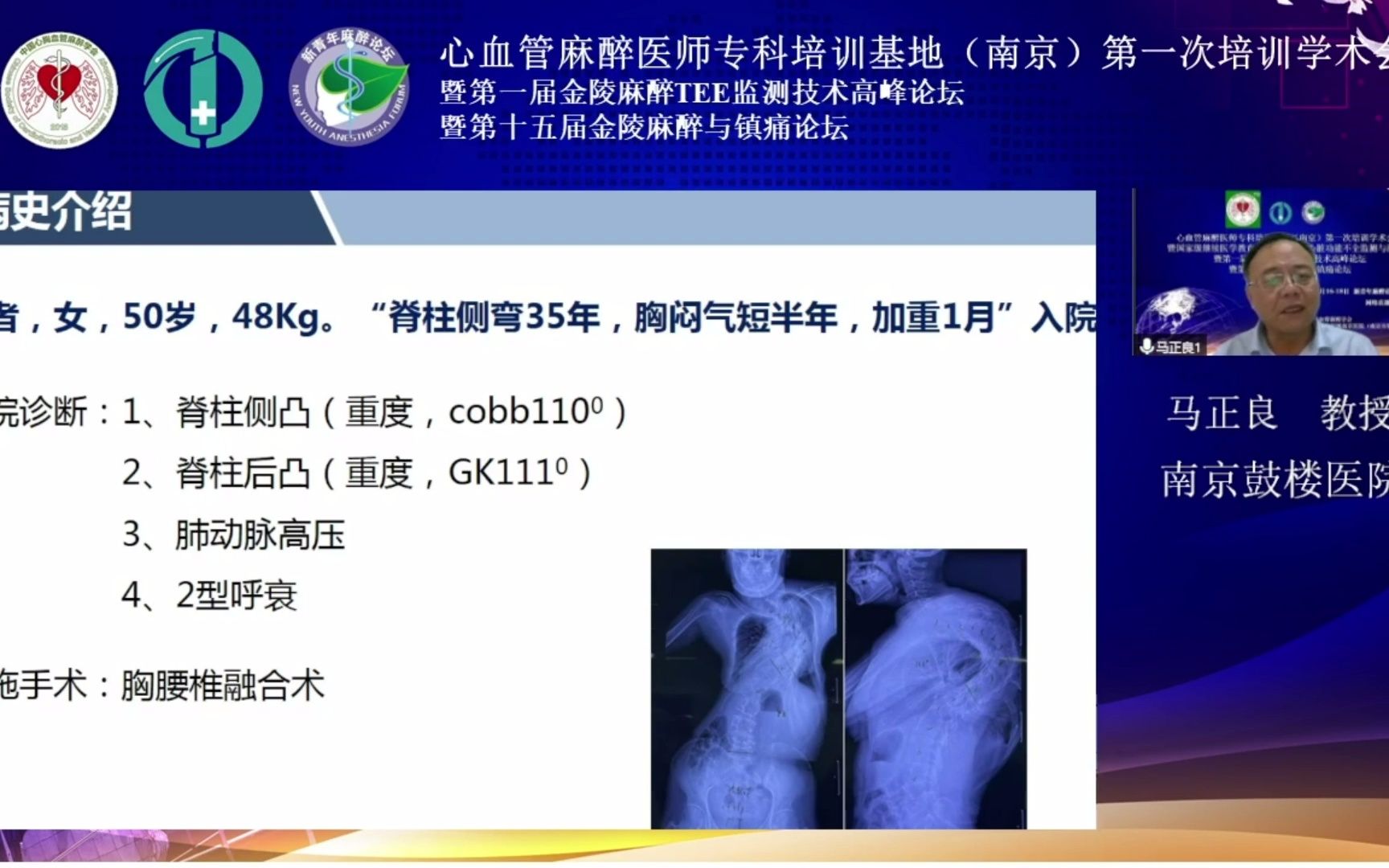 合并肺动脉高压患者非心脏手术的麻醉与围术期管理马正良教授哔哩哔哩bilibili