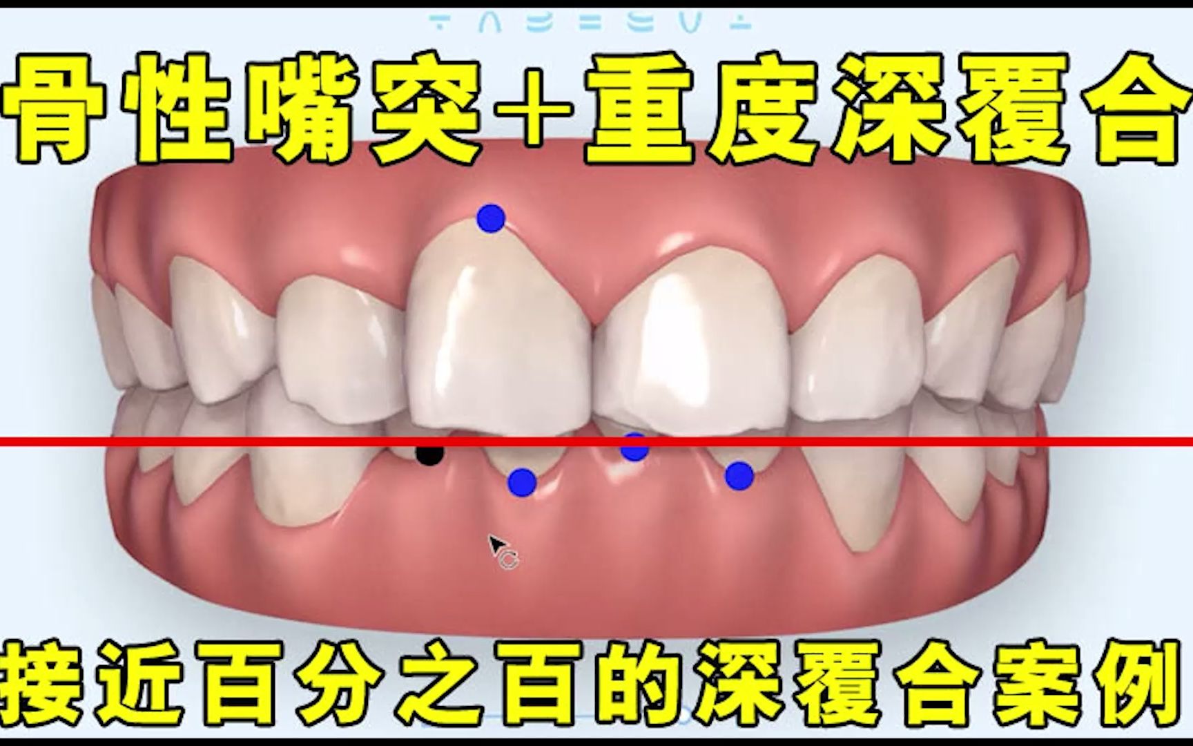 [图]【隐适美案例】骨性嘴突+重度深覆合案例