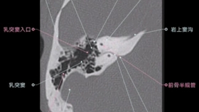 手把手教你进行超快速颞骨ct阅片 油管搬运 双语字幕 Ct Temporal Bone Anatomy 哔哩哔哩 つロ干杯 Bilibili