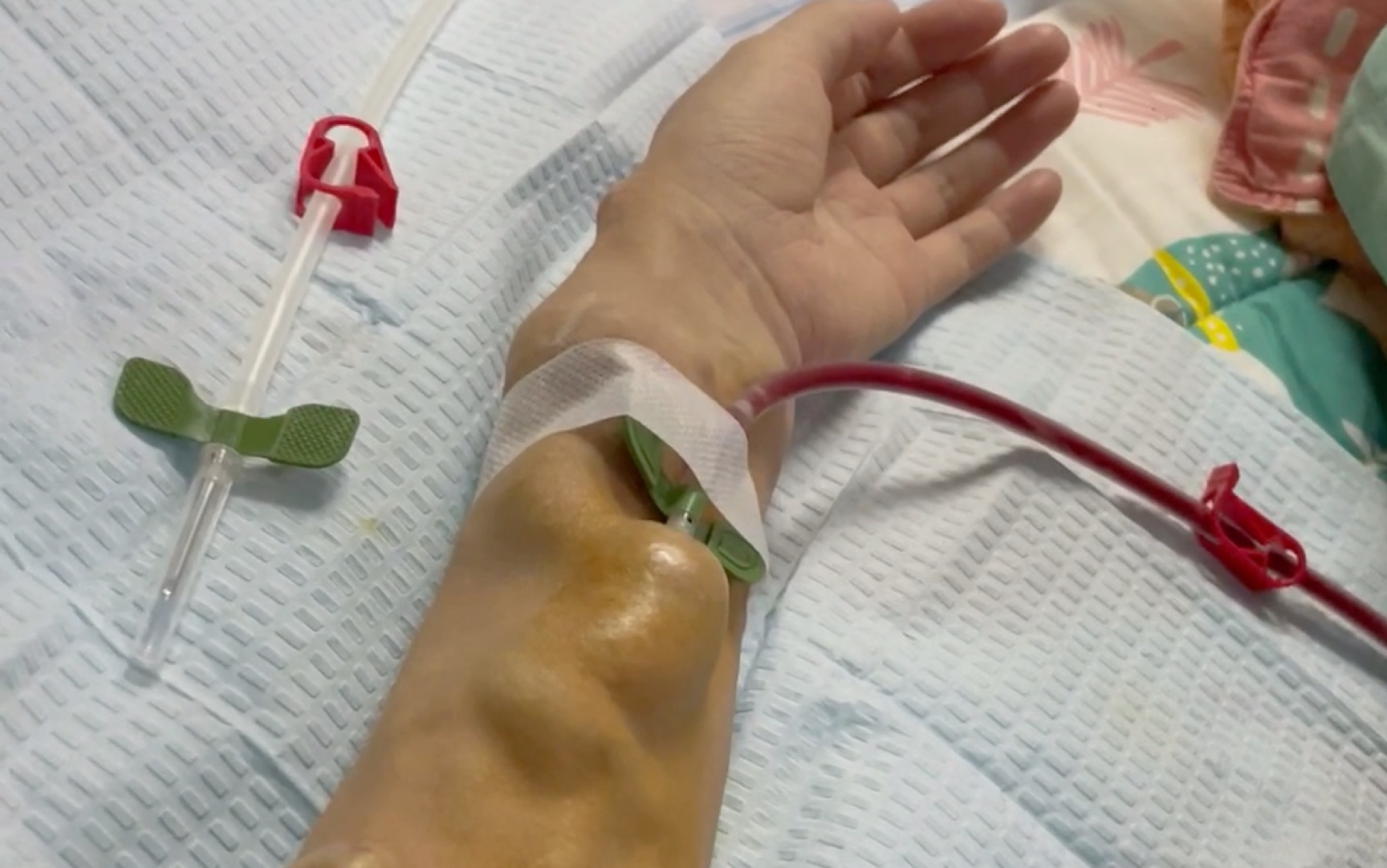 尿毒症24年小姐姐的血透片段