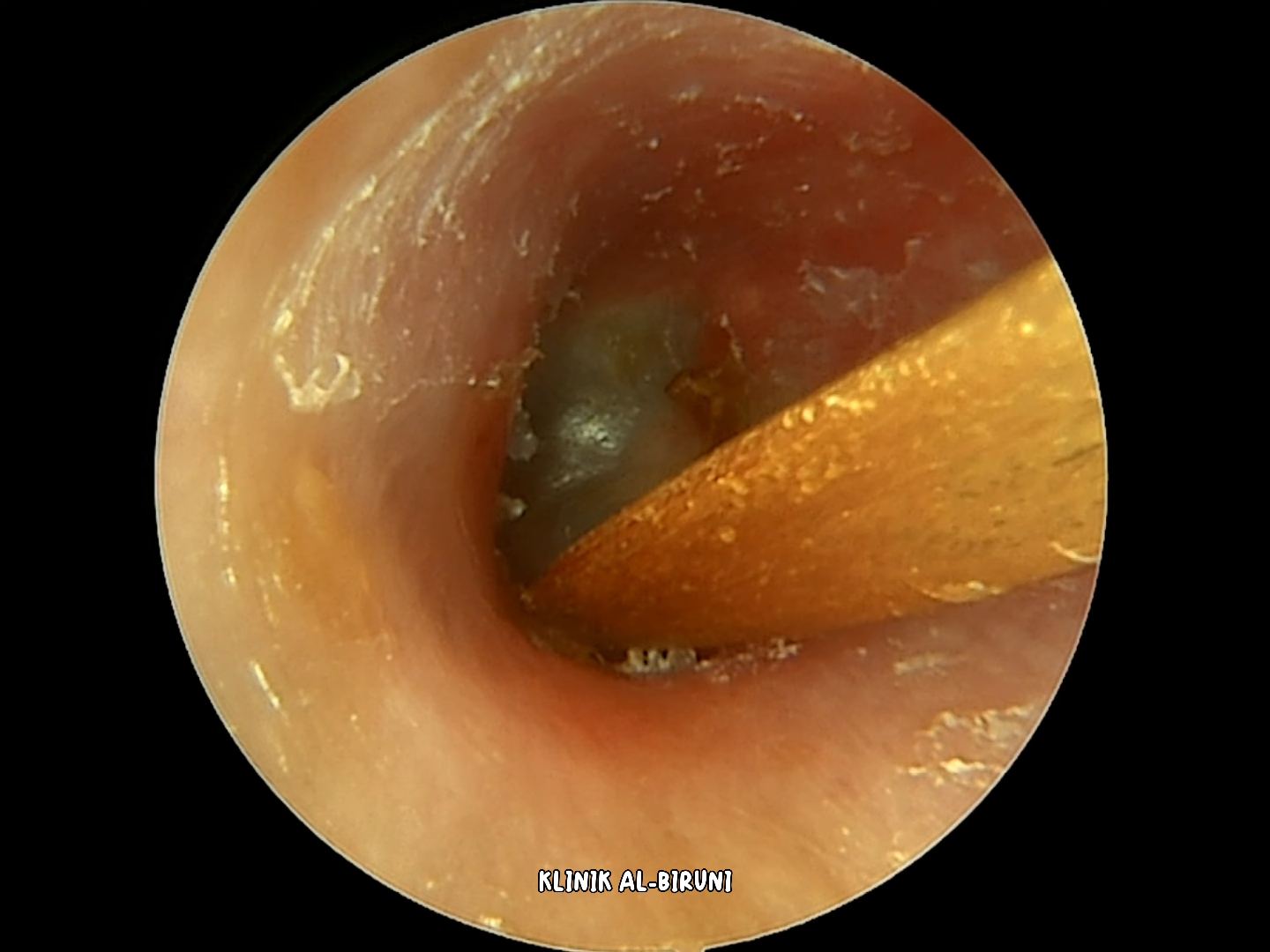 掏耳朵解压-金色结痂耳垢层已去除! (4k 60fps)