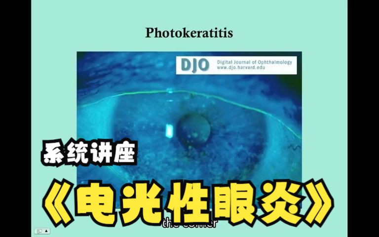 【中英双字】【电光性眼炎】Photokeratitis CRASH! Medical Review Series哔哩哔哩bilibili