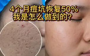 Download Video: 烂脸治好记录！4个月痘坑恢复50%，按我的方案来成效显著！