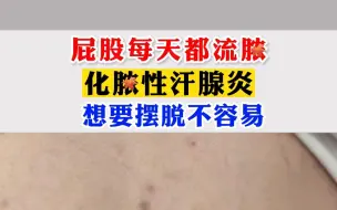 Download Video: 屁股每天都流脓，化脓性汗腺炎，想要摆脱不容易