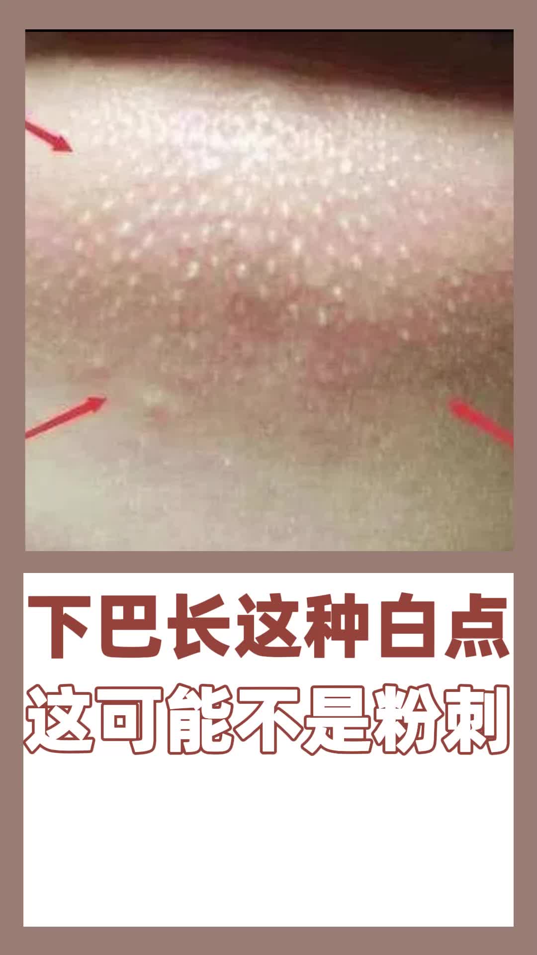 这可能不是白头粉刺,下巴长这种小白点注意了