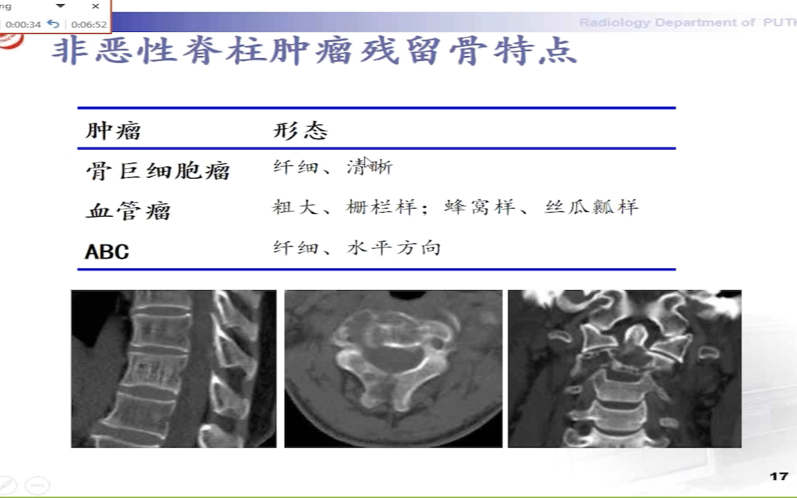 北京大学第三医院 袁源脊柱非恶性肿瘤的影像学检查及评估哔哩哔哩bilibili