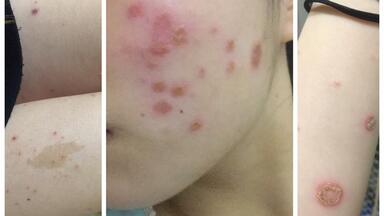 猫藓血泪史(人身上叫金钱藓/铜钱藓)  寝室弥漫了几天的84消毒液味儿