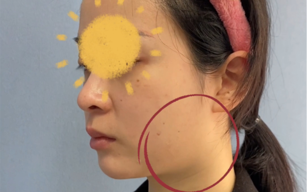 双下巴,轮廓不清晰,小姑娘正面脸型很窄,侧面双下巴拉低了颜值.