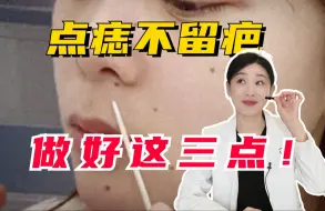 Descargar video: 想要点痣不留疤，做好这三点！