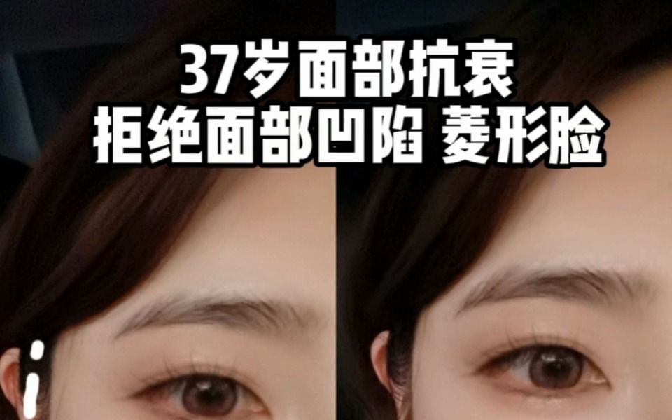 不用医美改善面部凹陷不注意夫妻宫不稳中国自古就有“天庭饱满,地阁方圆”的审美,认为面部轮廓的圆润与丰满,不仅美丽而且有福气.哔哩哔哩bilibili