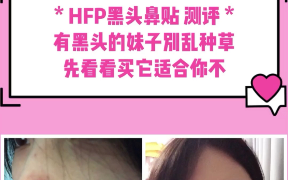 HFP黑头贴测评|看了不踩雷哔哩哔哩bilibili