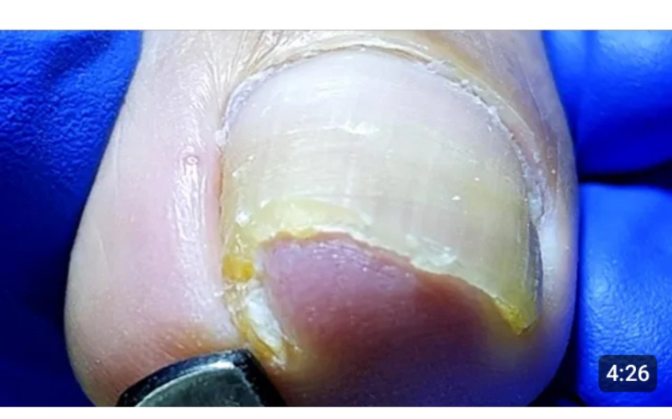 【超超超超解压系列66】甲沟炎拔地而起,家人们爽啊进来进来