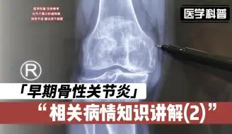 Download Video: 早期的骨性关节炎相关病情知识讲解，听听肖医生如何讲解(2)