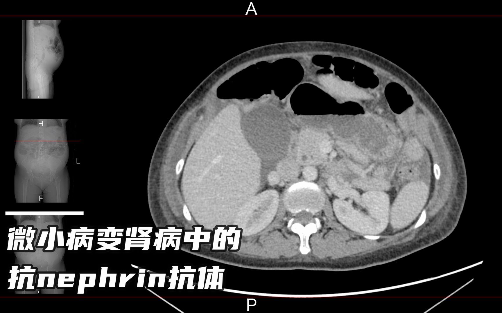 [图]肾脏病学新进展｜微小病变肾病中的抗nephrin抗体