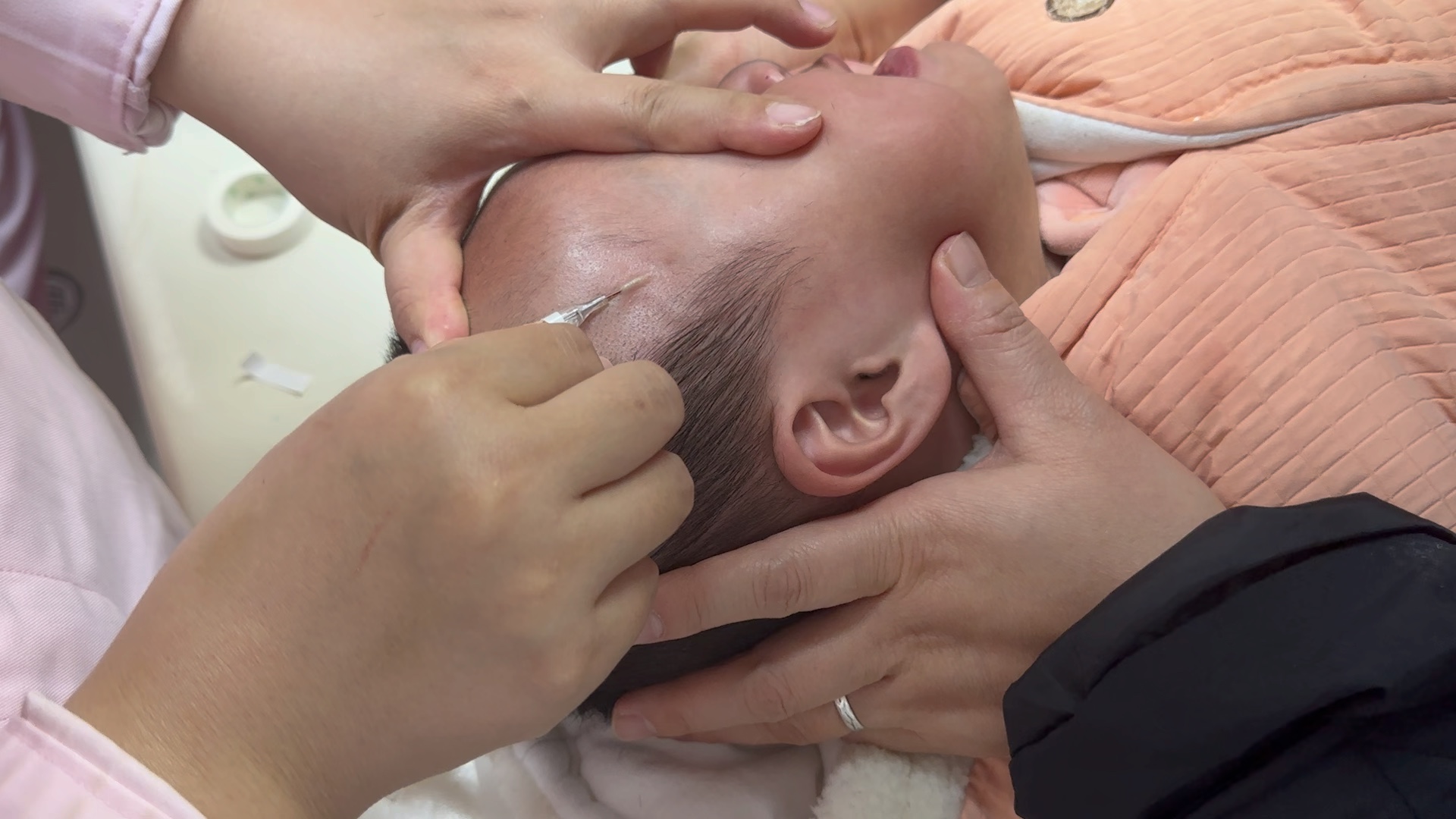 头皮静脉留置针穿刺——这个穿刺比较丝滑