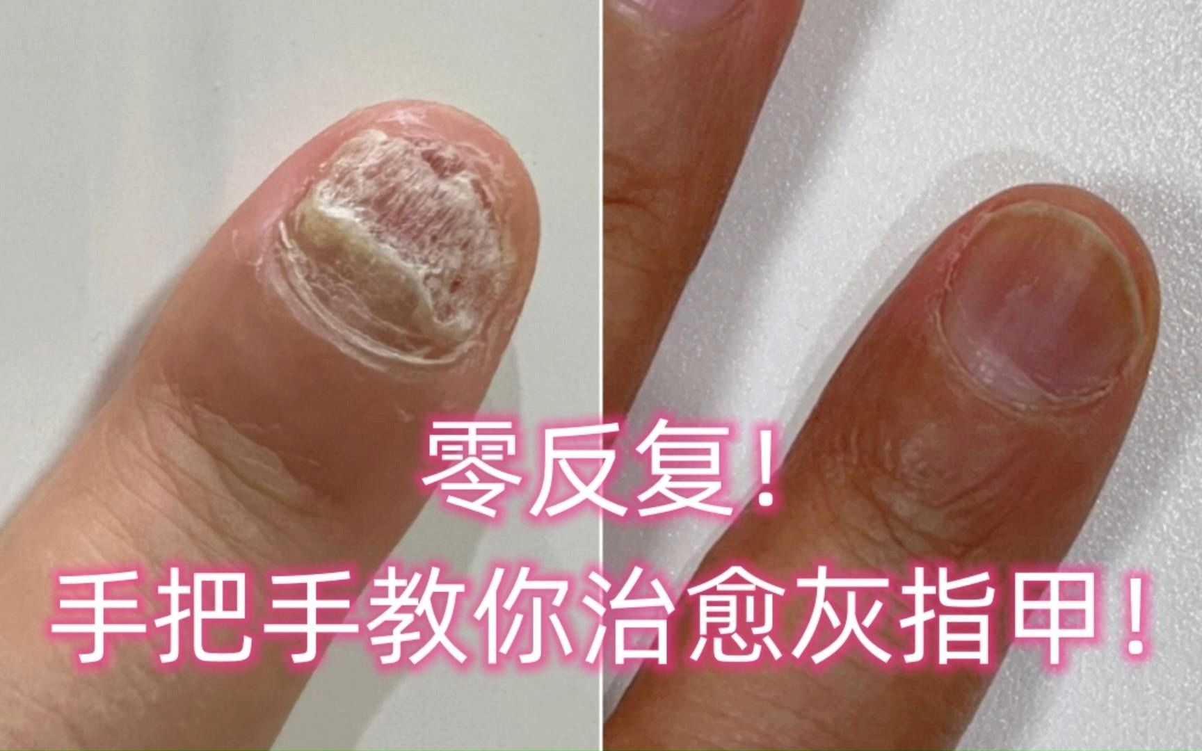 零反复!手把手教你治愈灰指甲!