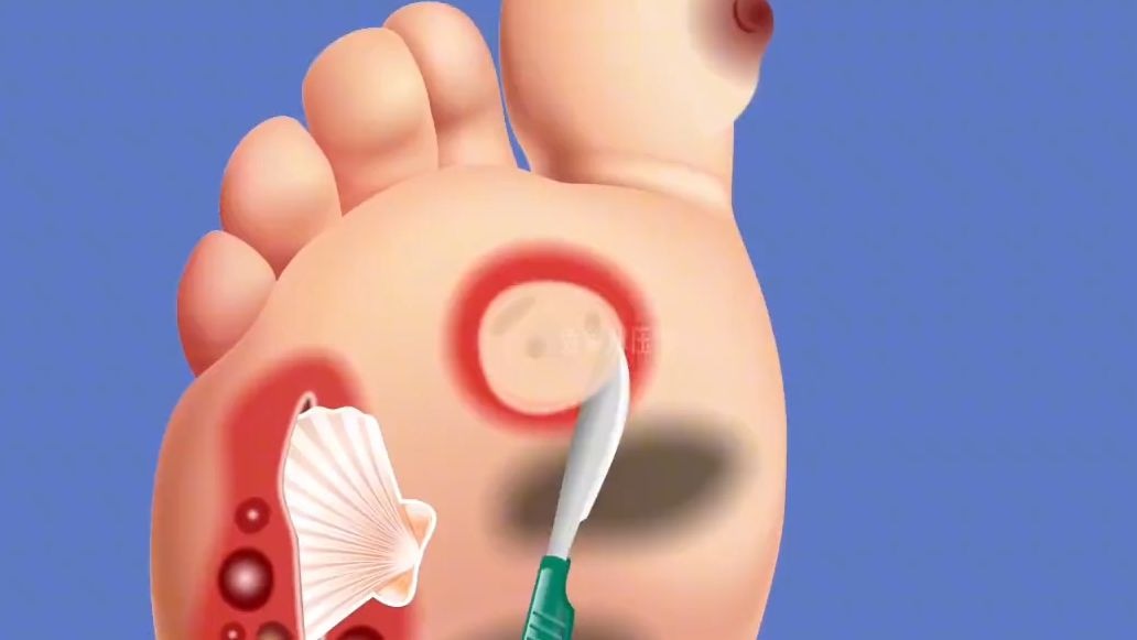 解压动画:我滴妈!这脚怎么肿成这样!