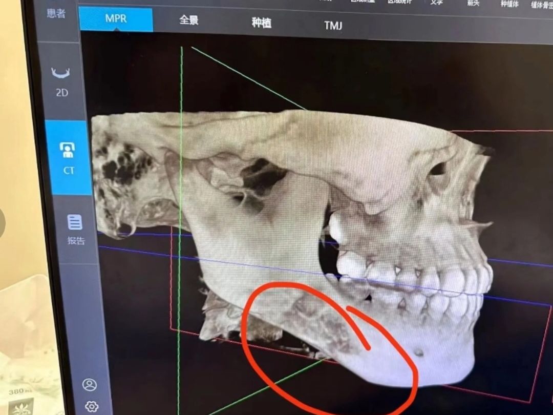 磨骨失败了怎么办?