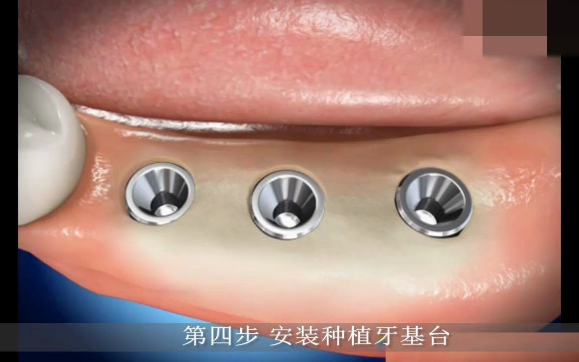 骨粉植入3d演示牙槽骨严重萎缩也能做种植牙