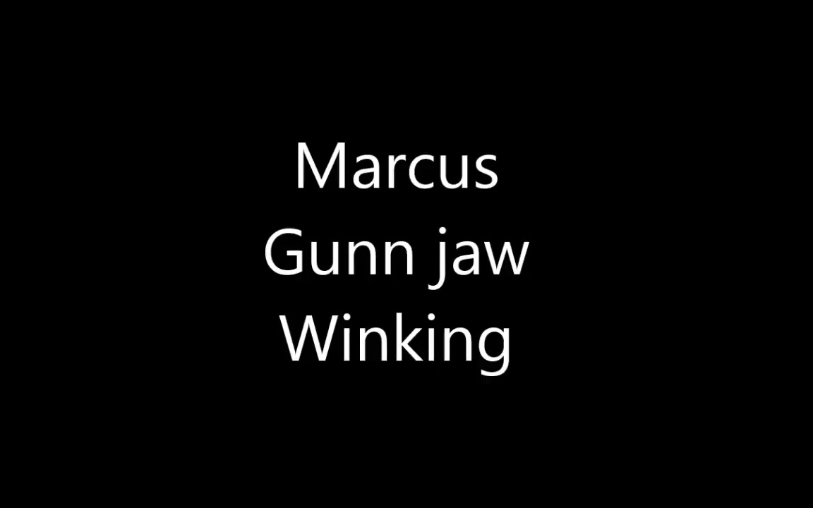 【中英双字】MarcusGunn综合征(下颌瞬目综合症)哔哩哔哩bilibili