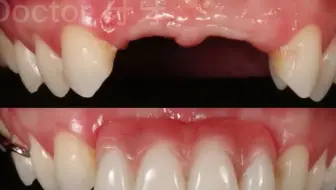 门牙缺失不用等三个月，马上过年了选择立马修复，隐形义齿