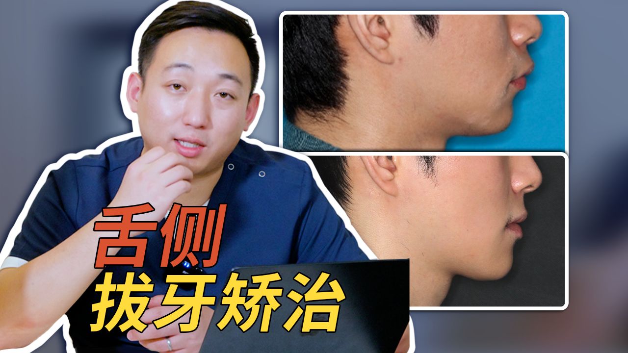舌侧矫正改善融合牙,舌隆突患者的嘴突问题