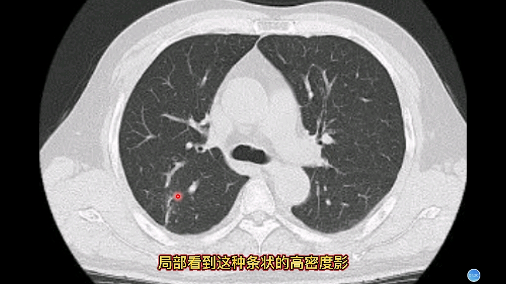 肺纤维灶图片图片