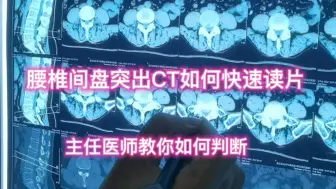 Download Video: 腰椎间盘突出怎么诊断？CT上如何读片，主任医师教你快速判断