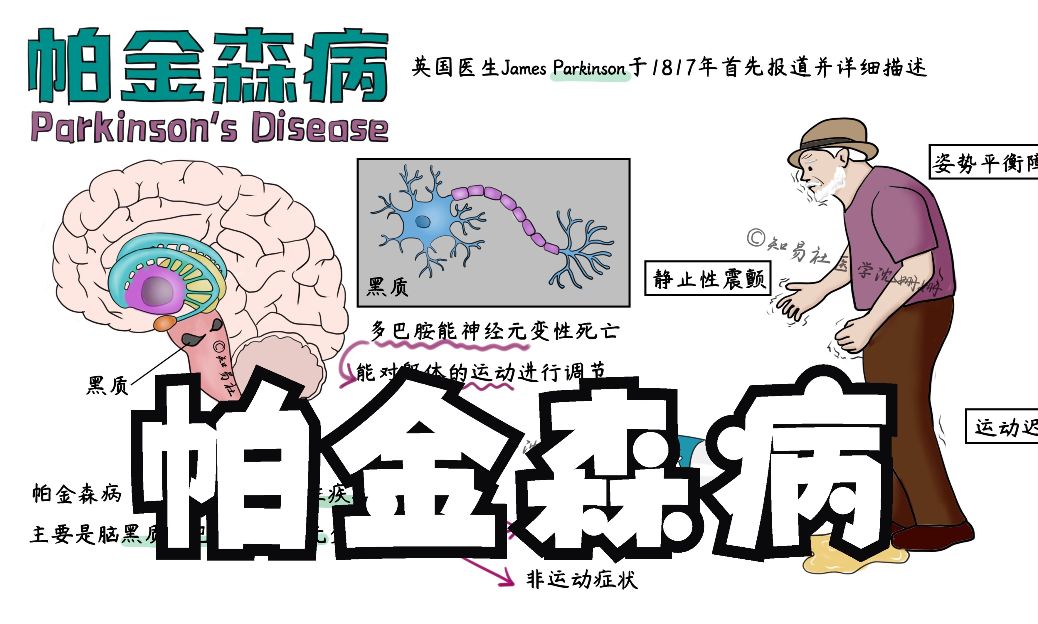 手绘精讲【帕金森病】|病因+发病机制+症状+药物+手术(DBS)哔哩哔哩bilibili