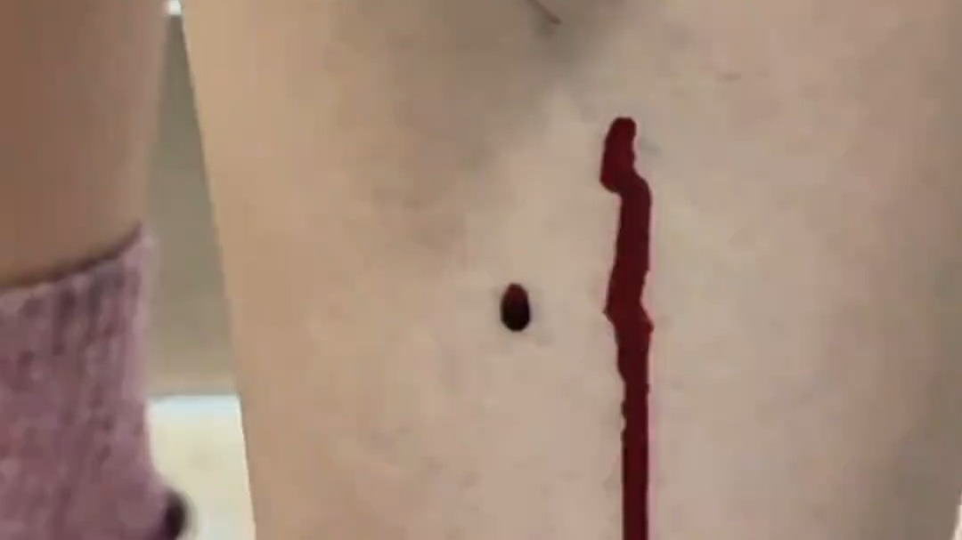 女子老寒腿，找中医扎针放血，网友：别扎了大夫，我已经在找秋裤了！
