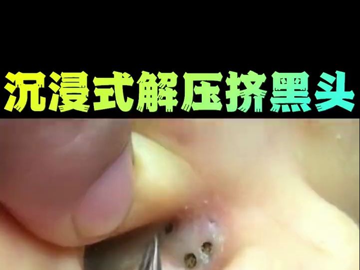 解压系列,过瘾挤痘痘去黑头,酸爽减压!