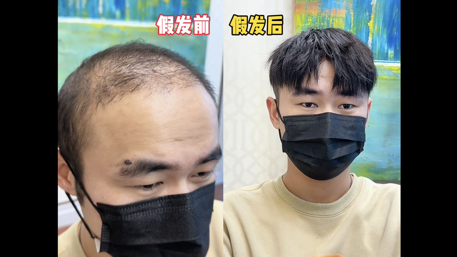 南京植发假发(南京植发怎样治疗)