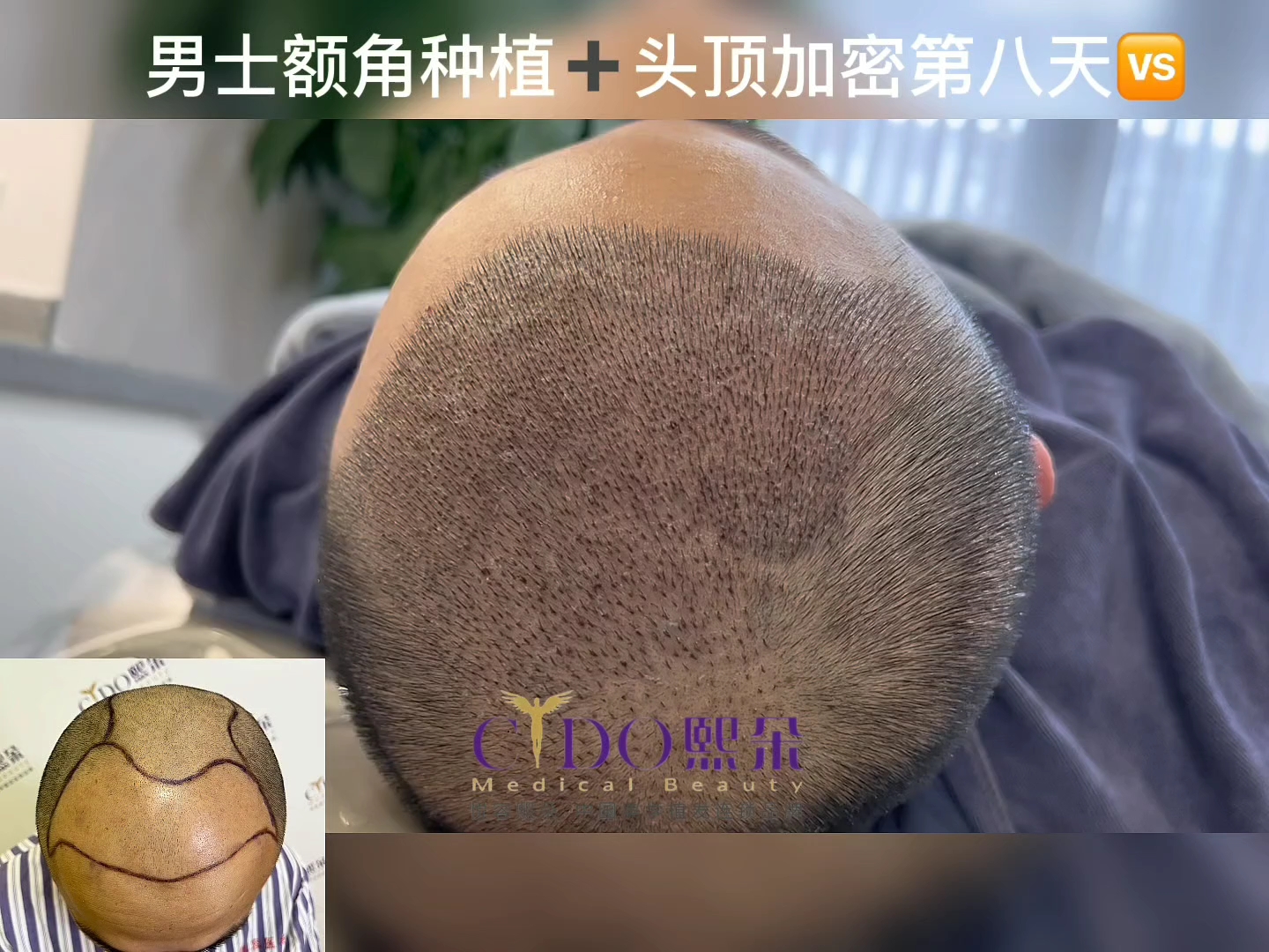 植发后第8天(植发后第8天头皮发痒可以喷生理盐水吗)