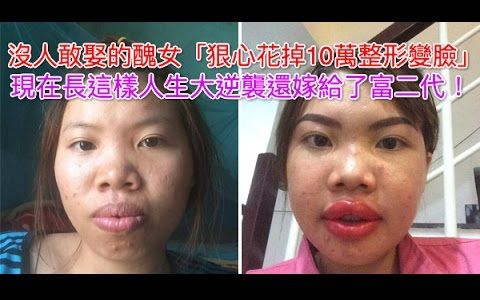 [图]没人敢娶的丑女「狠心花掉10万整形变脸」现在长这样人生大逆袭还嫁给了富二代！