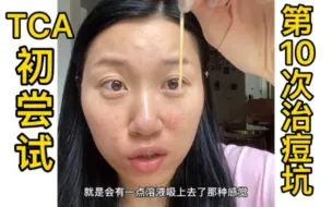 Tải video: 8年老痘坑TCA初尝试～第10次在家治痘坑～