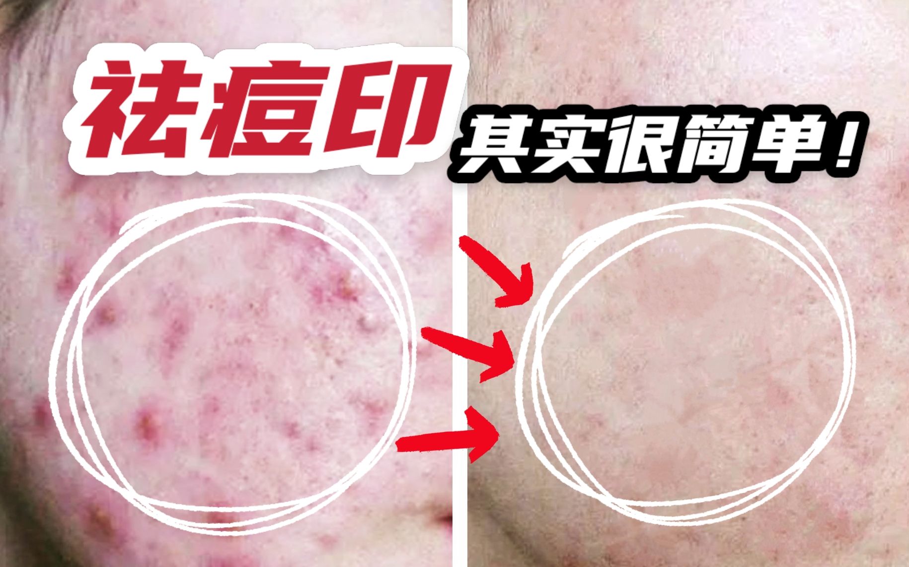 红黑痘印一键清零如何有效祛除顽固痘印保姆级干货