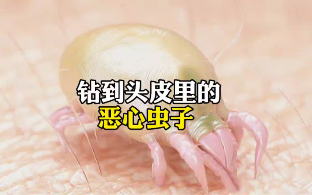 选到头皮里的恶心虫子