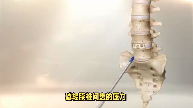 铁腰板治疗腰间盘突出管用,效果显著不反弹