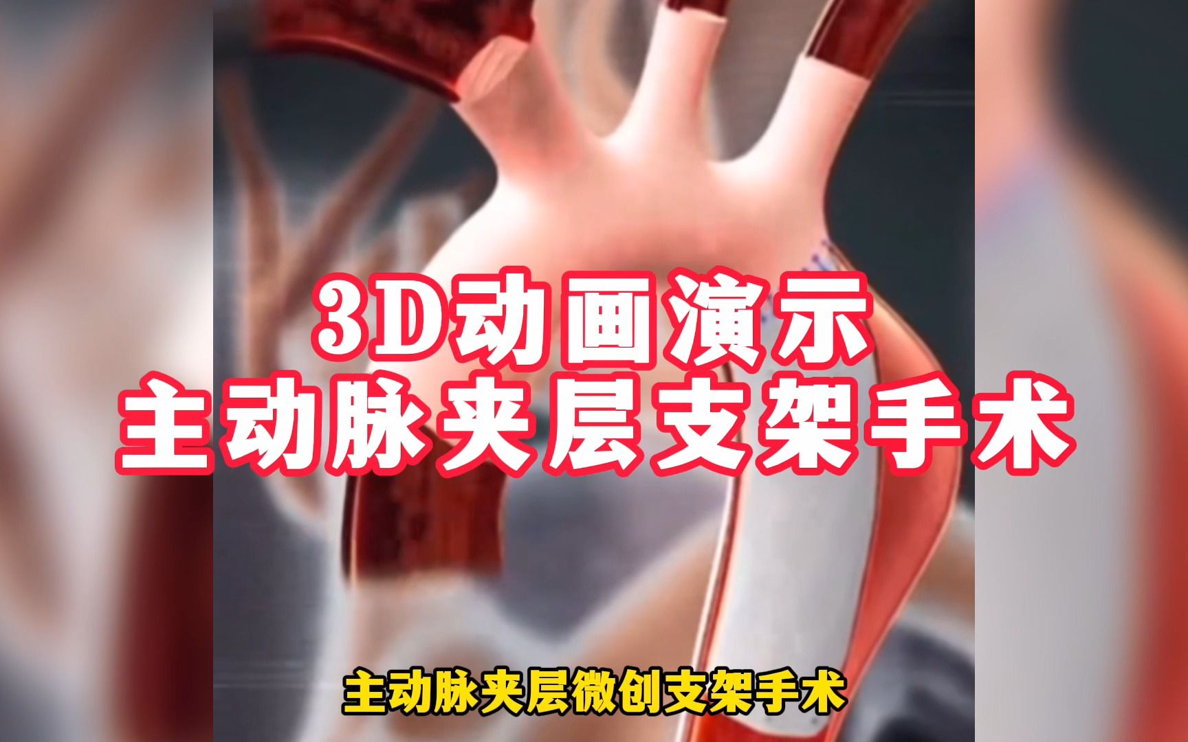 3D动画带你了解,主动脉夹层微创支架手术.哔哩哔哩bilibili